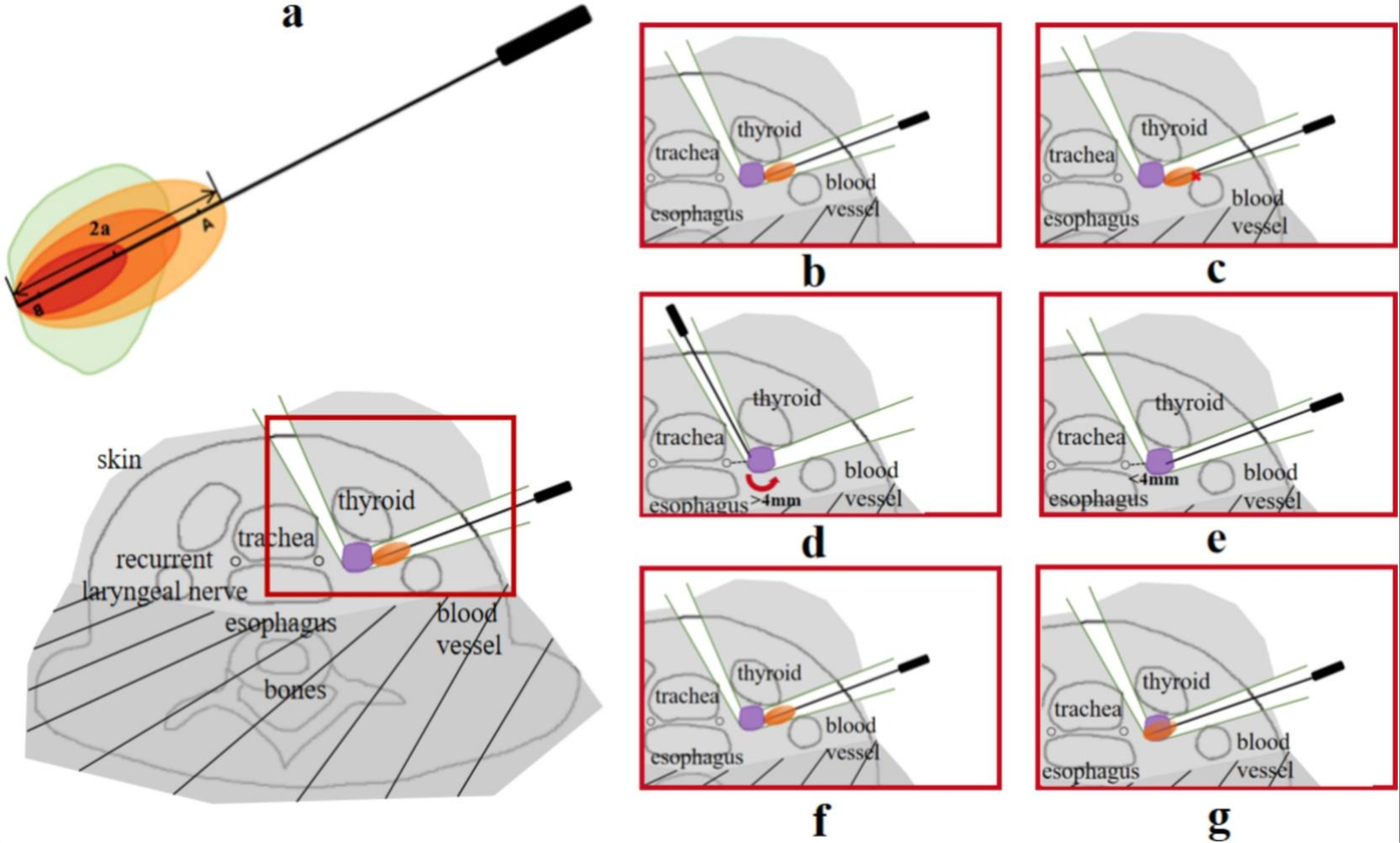 Puncture path planning for thermal ablation surgery of hyperparathyroidism based on multi-objective constraints